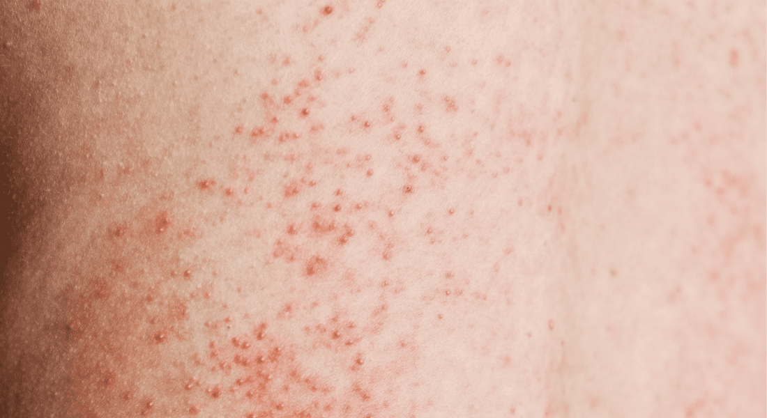 Folliculitis, the other F word | Queen Bee Salon & Spa
